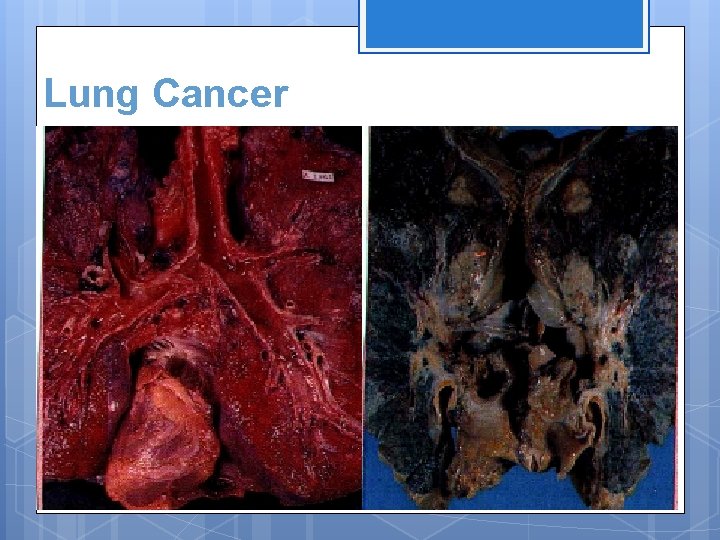 Lung Cancer 