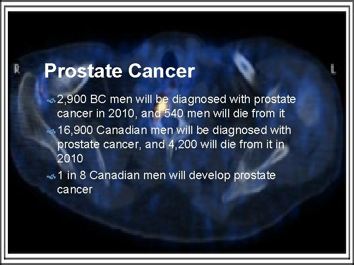 Prostate Cancer 2, 900 BC men will be diagnosed with prostate cancer in 2010,