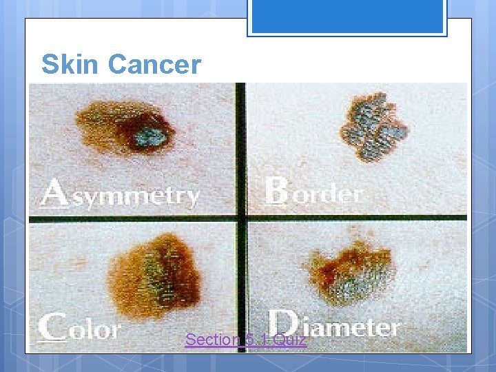 Skin Cancer Section 5. 1 Quiz 