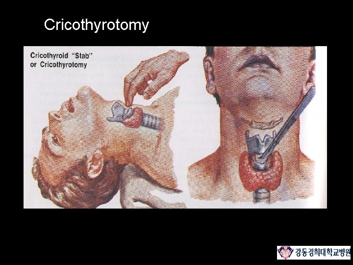 Contents 1 Anatomy 2 Patient Evaluation 3 Endotracheal