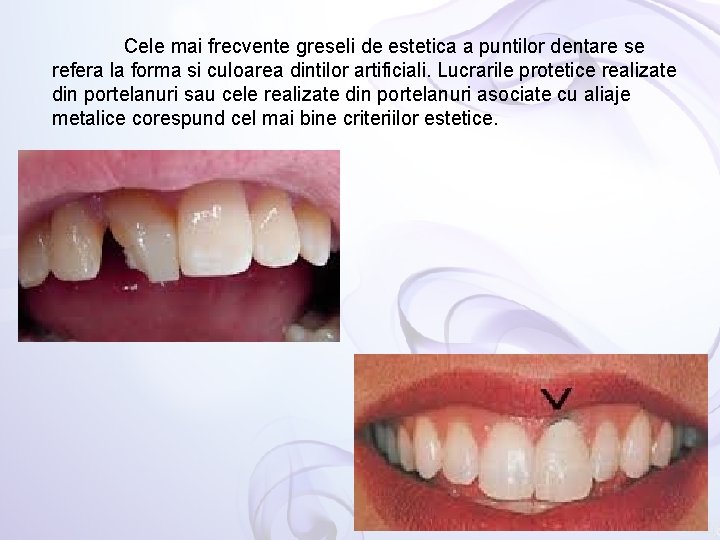 Cele mai frecvente greseli de estetica a puntilor dentare se refera la forma si