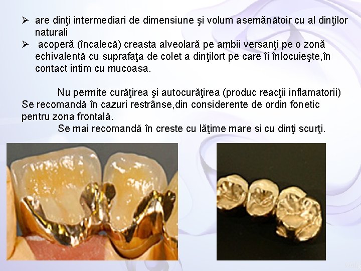Ø are dinţi intermediari de dimensiune şi volum asemănătoir cu al dinţilor naturali Ø
