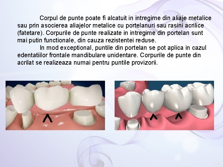 Corpul de punte poate fi alcatuit in intregime din aliaje metalice sau prin asocierea