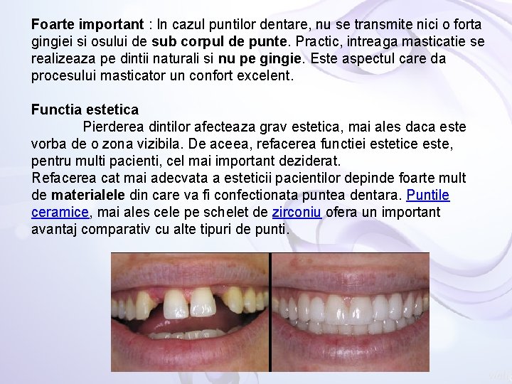 Foarte important : In cazul puntilor dentare, nu se transmite nici o forta gingiei
