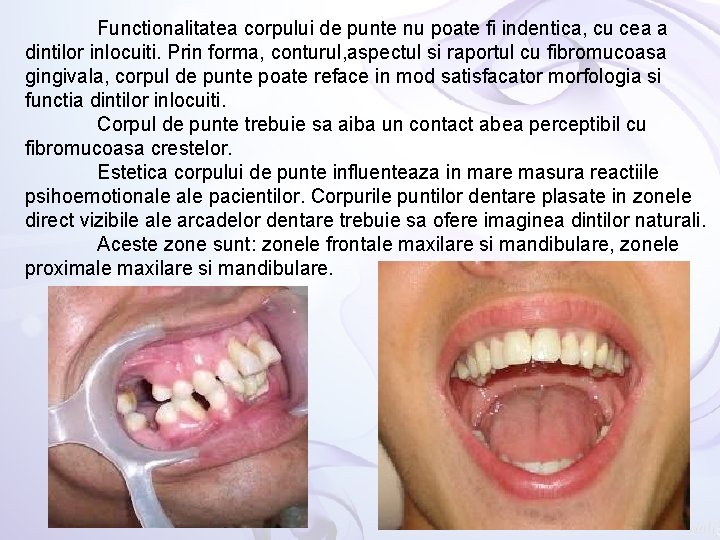 Functionalitatea corpului de punte nu poate fi indentica, cu cea a dintilor inlocuiti. Prin