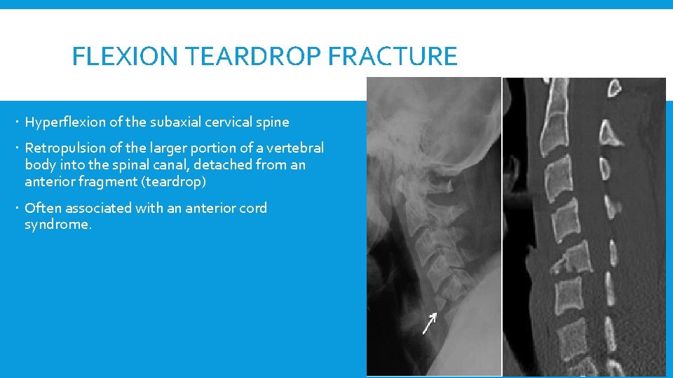 FLEXION TEARDROP FRACTURE Hyperflexion of the subaxial cervical spine Retropulsion of the larger portion