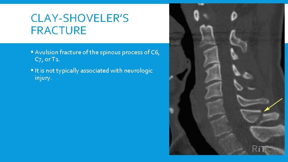 CLAY-SHOVELER’S FRACTURE § Avulsion fracture of the spinous process of C 6, C 7,
