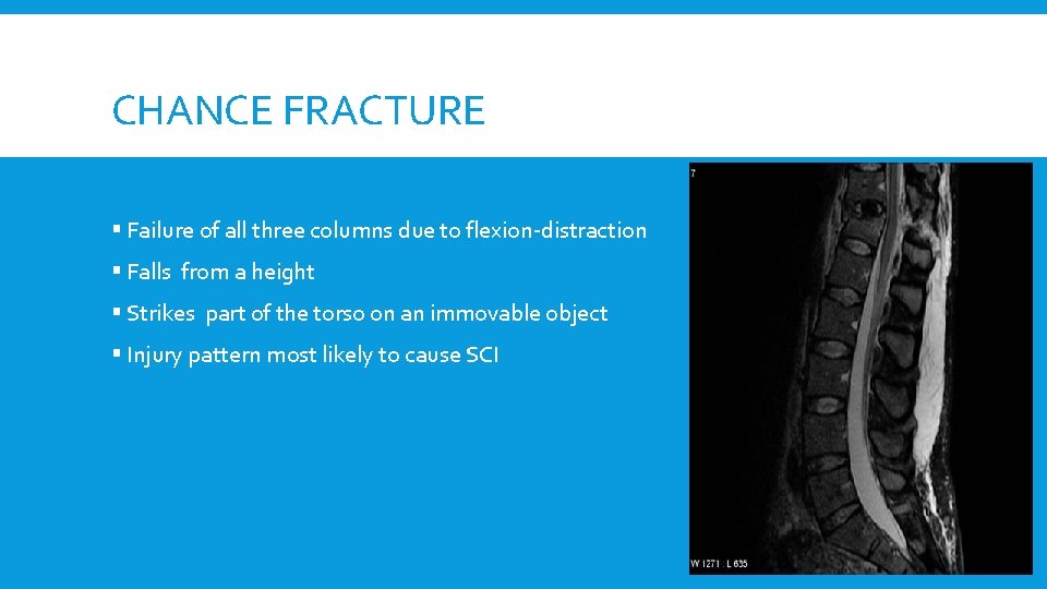 CHANCE FRACTURE § Failure of all three columns due to flexion-distraction § Falls from