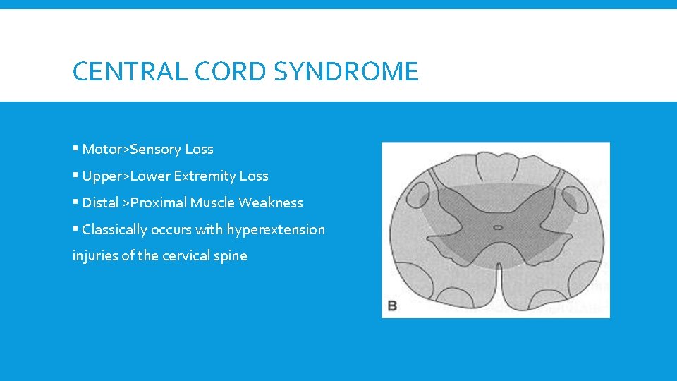 CENTRAL CORD SYNDROME § Motor>Sensory Loss § Upper>Lower Extremity Loss § Distal >Proximal Muscle