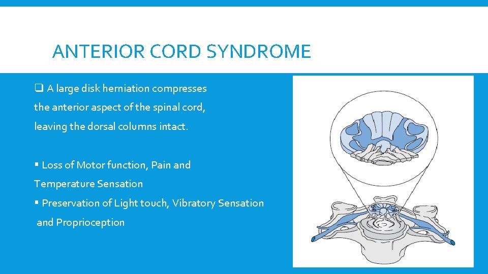 ANTERIOR CORD SYNDROME q A large disk herniation compresses the anterior aspect of the