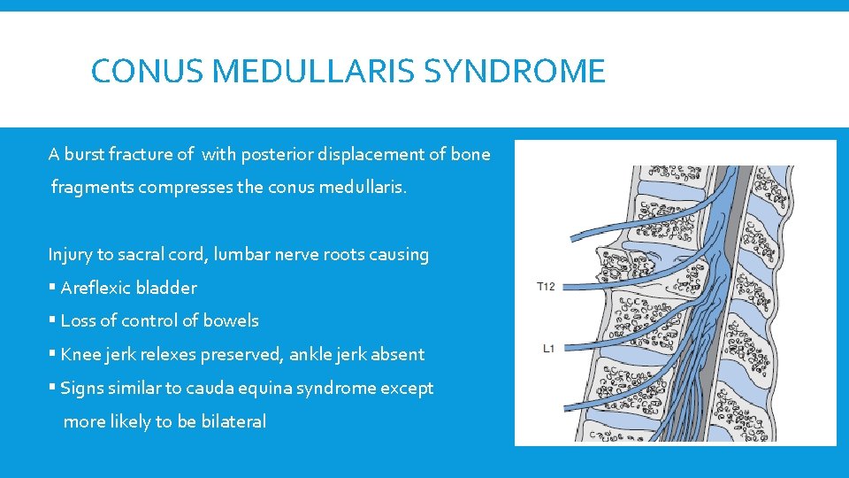 CONUS MEDULLARIS SYNDROME A burst fracture of with posterior displacement of bone fragments compresses