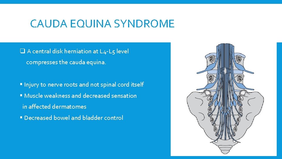 CAUDA EQUINA SYNDROME q A central disk herniation at L 4 -L 5 level