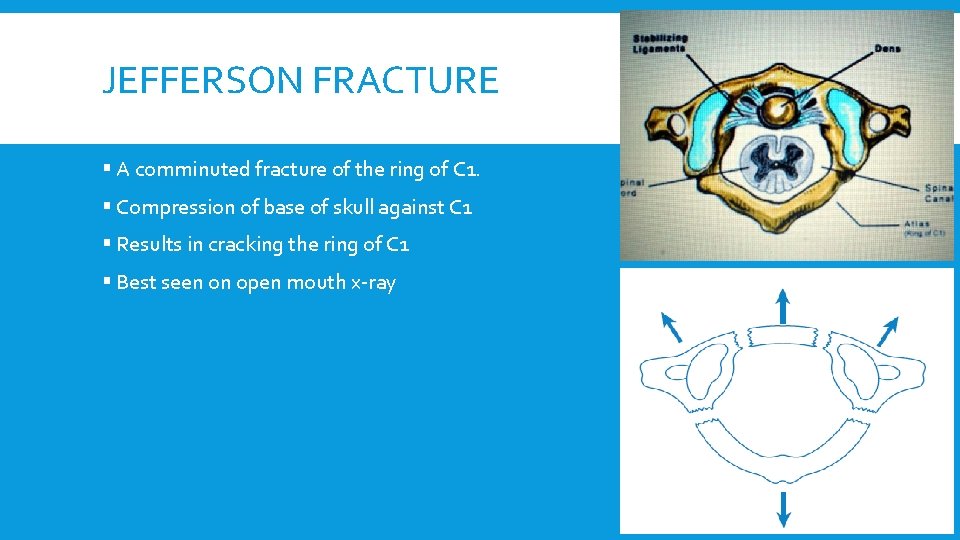 JEFFERSON FRACTURE § A comminuted fracture of the ring of C 1. § Compression