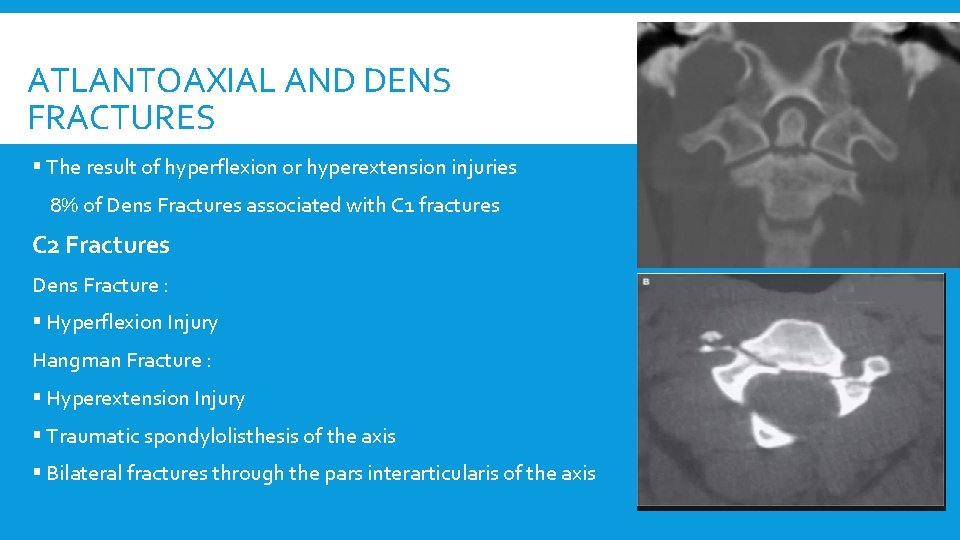 ATLANTOAXIAL AND DENS FRACTURES § The result of hyperflexion or hyperextension injuries 8% of