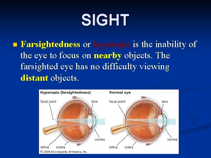 SIGHT n Farsightedness or hyperopia is the inability of the eye to focus on