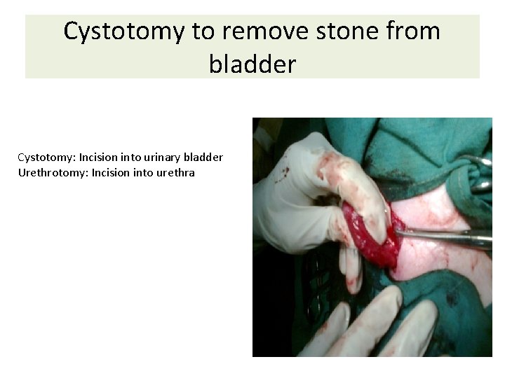 Cystotomy to remove stone from bladder Cystotomy: Incision into urinary bladder Urethrotomy: Incision into