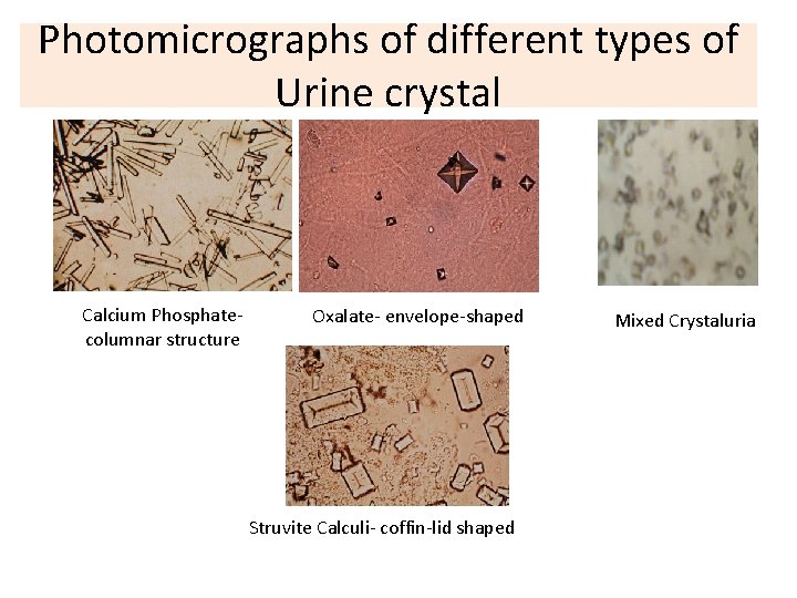 Photomicrographs of different types of Urine crystal Calcium Phosphatecolumnar structure Oxalate- envelope-shaped Struvite Calculi-