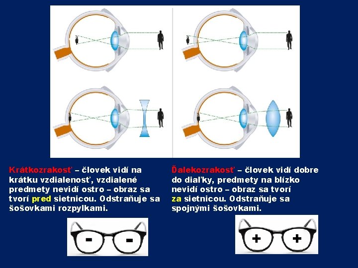 Krátkozrakosť – človek vidí na krátku vzdialenosť, vzdialené predmety nevidí ostro – obraz sa