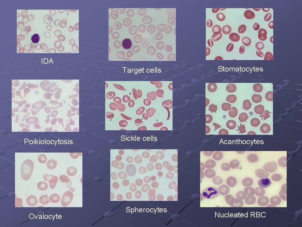 IDA Poikiolocytosis Ovalocyte Target cells Stomatocytes Sickle cells Acanthocytes Spherocytes Nucleated RBC 