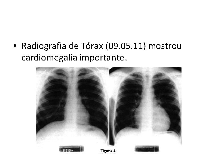  • Radiografia de Tórax (09. 05. 11) mostrou cardiomegalia importante. 