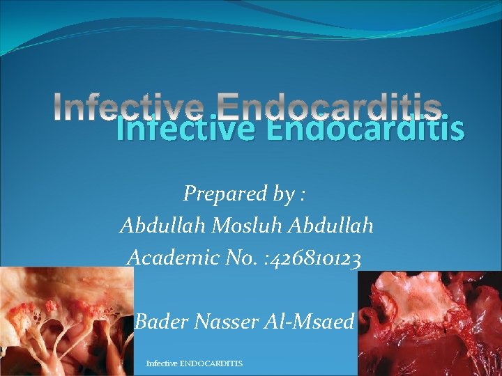 Infective Endocarditis Prepared by : Abdullah Mosluh Abdullah Academic No. : 426810123 Bader Nasser