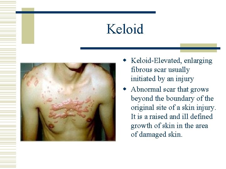 Keloid w Keloid-Elevated, enlarging fibrous scar usually initiated by an injury w Abnormal scar