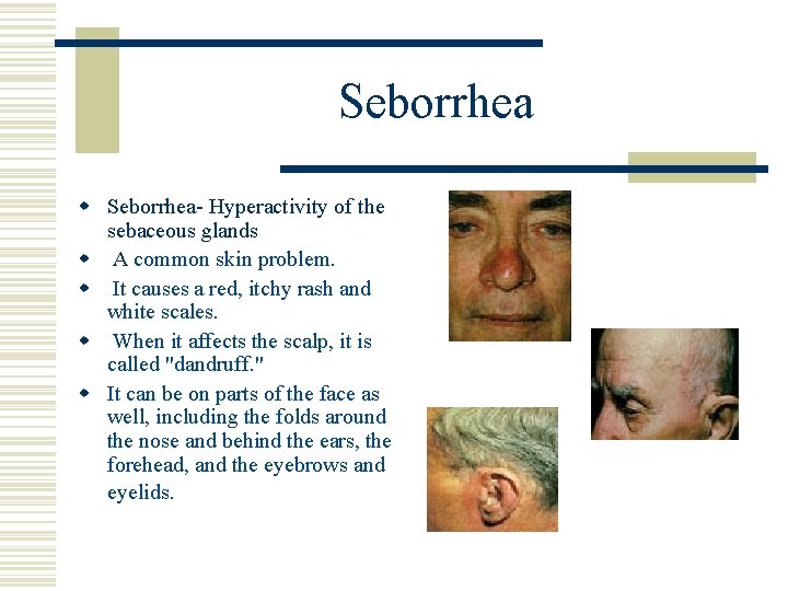 Seborrhea w Seborrhea- Hyperactivity of the sebaceous glands w A common skin problem. w