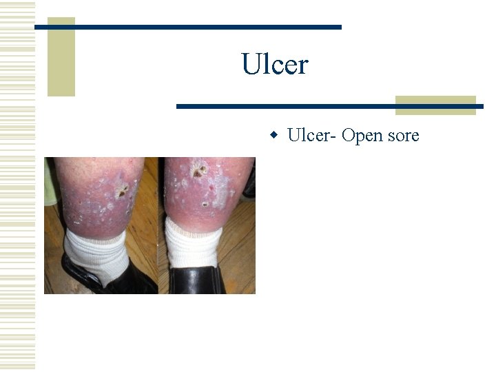 Ulcer w Ulcer- Open sore 