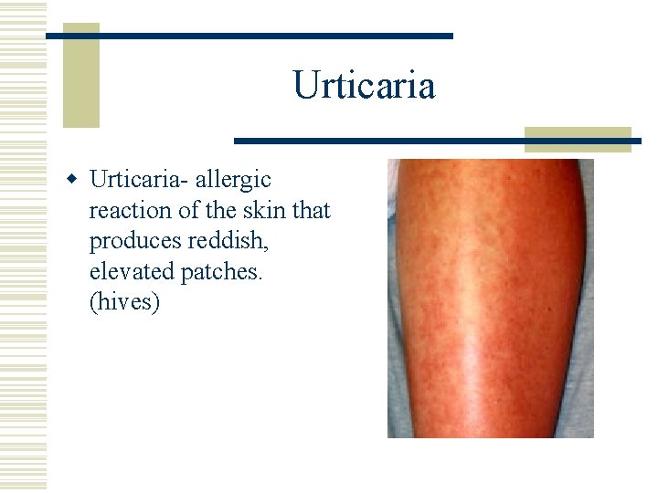 Urticaria w Urticaria- allergic reaction of the skin that produces reddish, elevated patches. (hives)