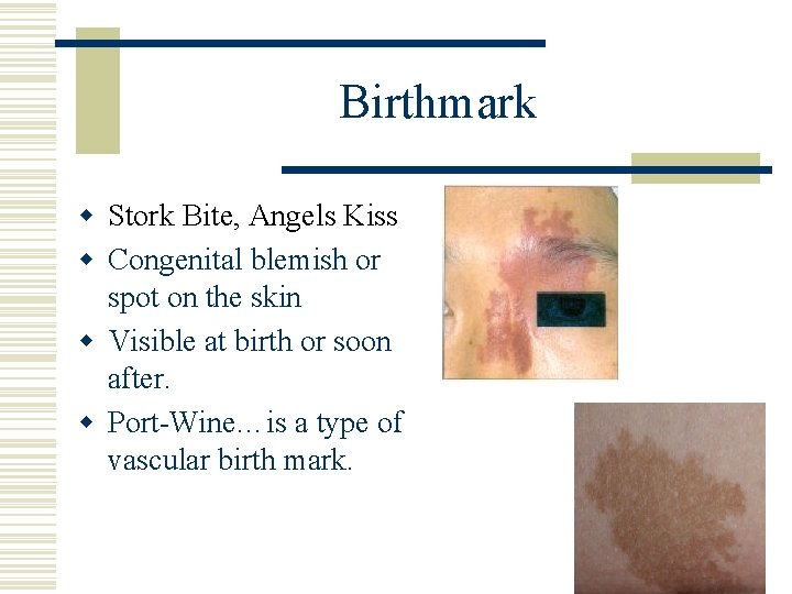 Birthmark w Stork Bite, Angels Kiss w Congenital blemish or spot on the skin