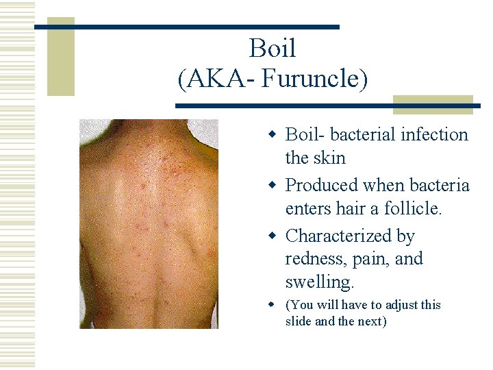 Boil (AKA- Furuncle) w Boil- bacterial infection the skin w Produced when bacteria enters