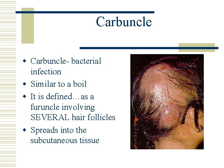 Carbuncle w Carbuncle- bacterial infection w Similar to a boil w It is defined…as