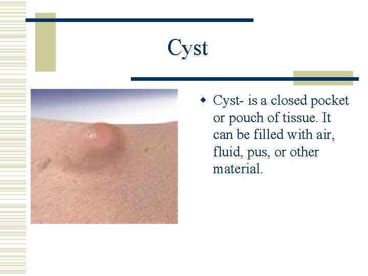 Cyst w Cyst- is a closed pocket or pouch of tissue. It can be