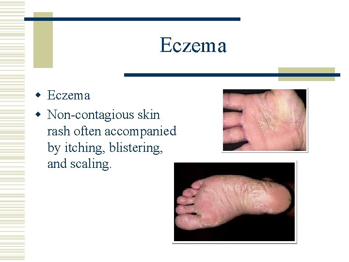 Eczema w Non-contagious skin rash often accompanied by itching, blistering, and scaling. 