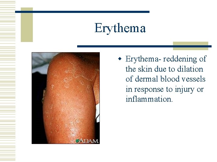 Erythema w Erythema- reddening of the skin due to dilation of dermal blood vessels