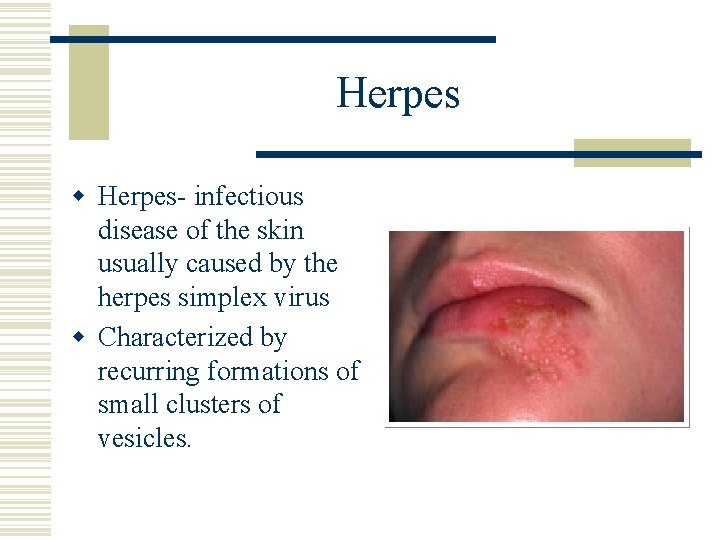 Herpes w Herpes- infectious disease of the skin usually caused by the herpes simplex