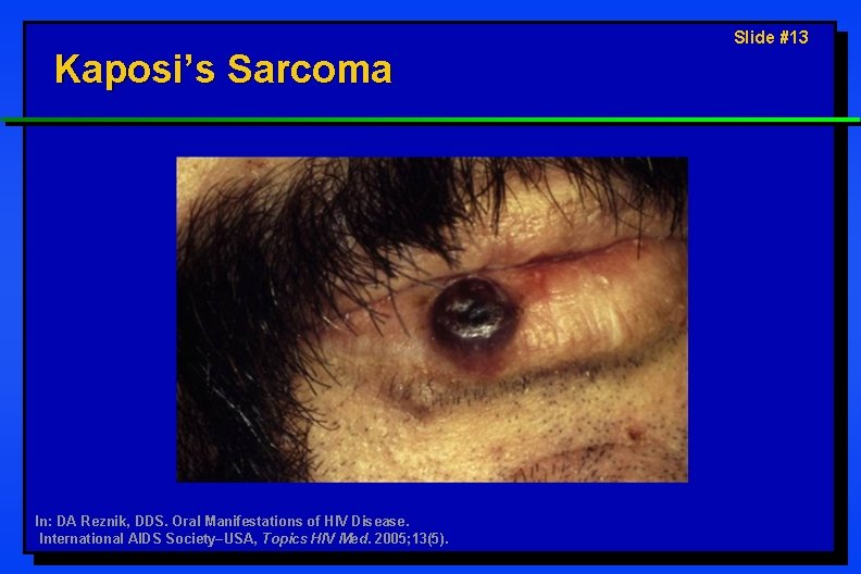 Kaposi’s Sarcoma In: DA Reznik, DDS. Oral Manifestations of HIV Disease. International AIDS Society–USA,