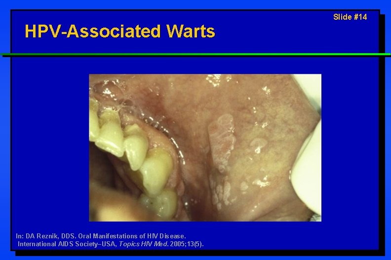 HPV-Associated Warts In: DA Reznik, DDS. Oral Manifestations of HIV Disease. International AIDS Society–USA,