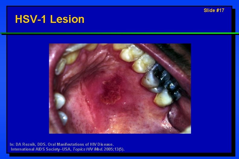 HSV-1 Lesion In: DA Reznik, DDS. Oral Manifestations of HIV Disease. International AIDS Society–USA,