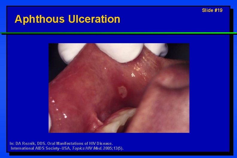 Aphthous Ulceration In: DA Reznik, DDS. Oral Manifestations of HIV Disease. International AIDS Society–USA,