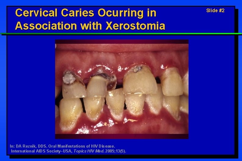 Cervical Caries Ocurring in Association with Xerostomia In: DA Reznik, DDS. Oral Manifestations of