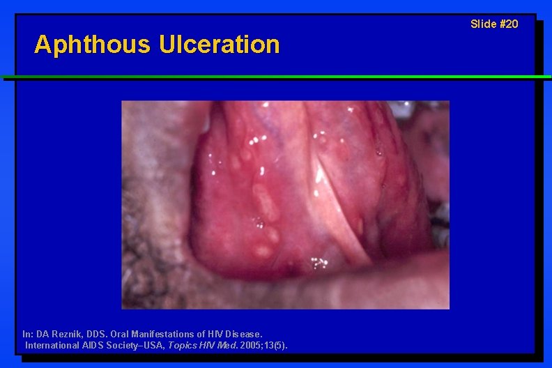 Aphthous Ulceration In: DA Reznik, DDS. Oral Manifestations of HIV Disease. International AIDS Society–USA,