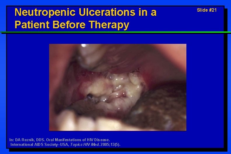 Neutropenic Ulcerations in a Patient Before Therapy In: DA Reznik, DDS. Oral Manifestations of
