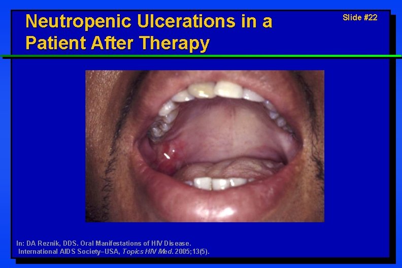 Neutropenic Ulcerations in a Patient After Therapy In: DA Reznik, DDS. Oral Manifestations of