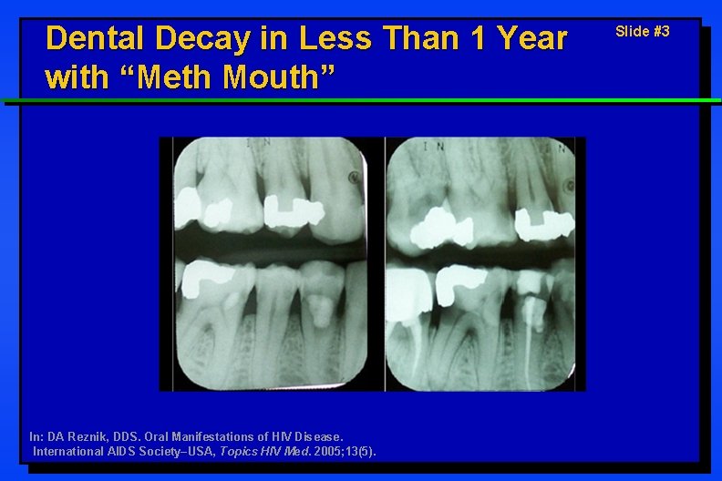 Dental Decay in Less Than 1 Year with “Meth Mouth” In: DA Reznik, DDS.