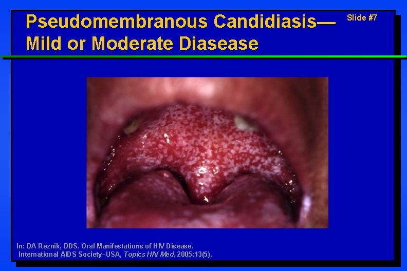 Pseudomembranous Candidiasis— Mild or Moderate Diasease In: DA Reznik, DDS. Oral Manifestations of HIV