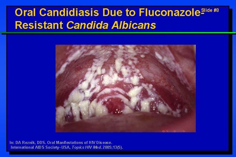 Oral Candidiasis Due to Fluconazole. Resistant Candida Albicans Slide #8 In: DA Reznik, DDS.