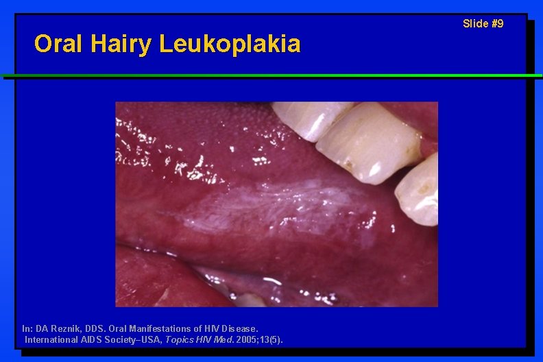 Oral Hairy Leukoplakia In: DA Reznik, DDS. Oral Manifestations of HIV Disease. International AIDS