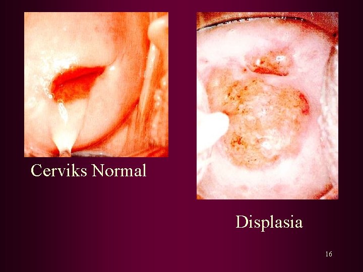 Cerviks Normal Displasia 16 Cerviks Normal Displasia 16