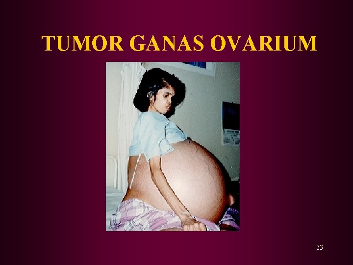 TUMOR GANAS OVARIUM 33 